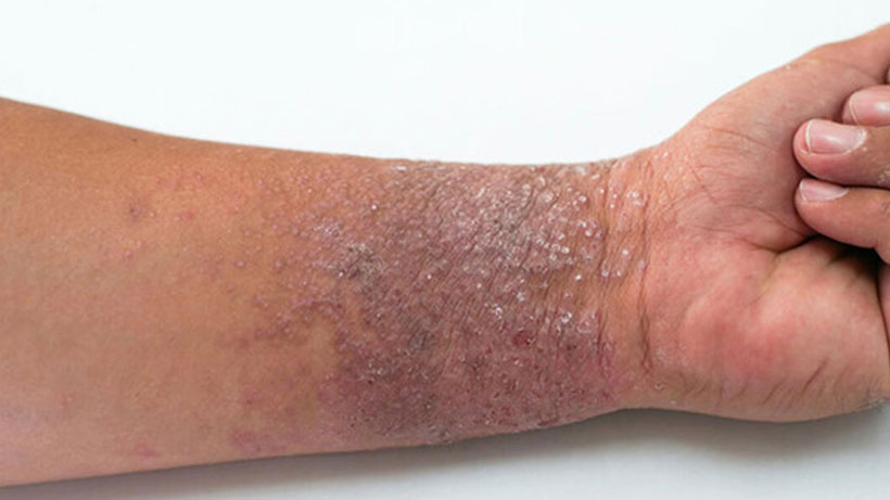 Eczema Skin on Arm near Wrist