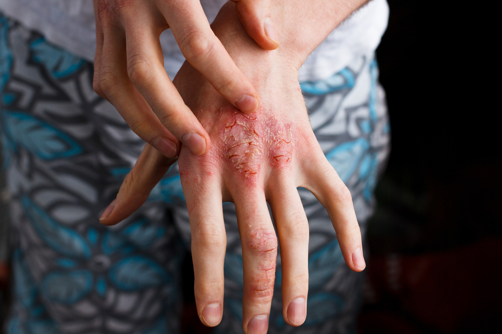 What is the difference between dermatitis and eczema?