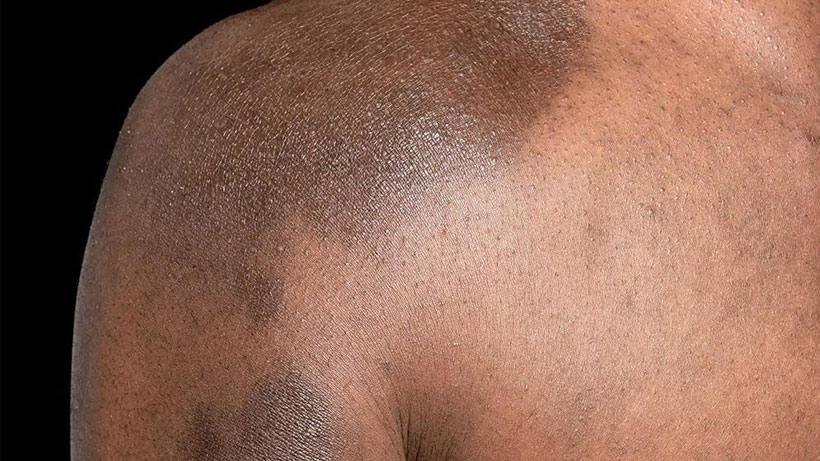 Eczema Skin on Shoulder