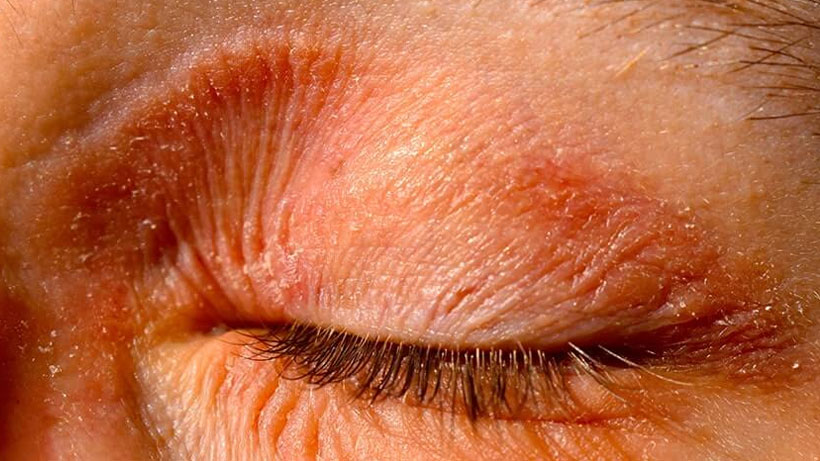 Eczema Skin Eye