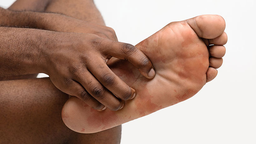 Eczema Skin on Feet