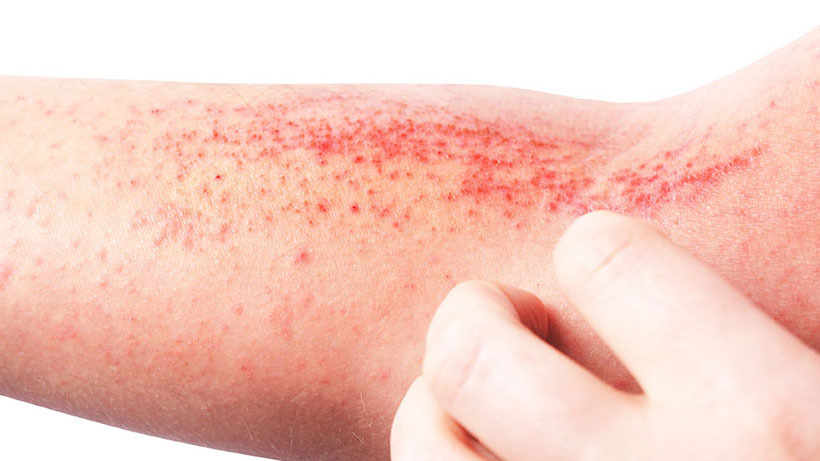 Eczema Skin on Arm