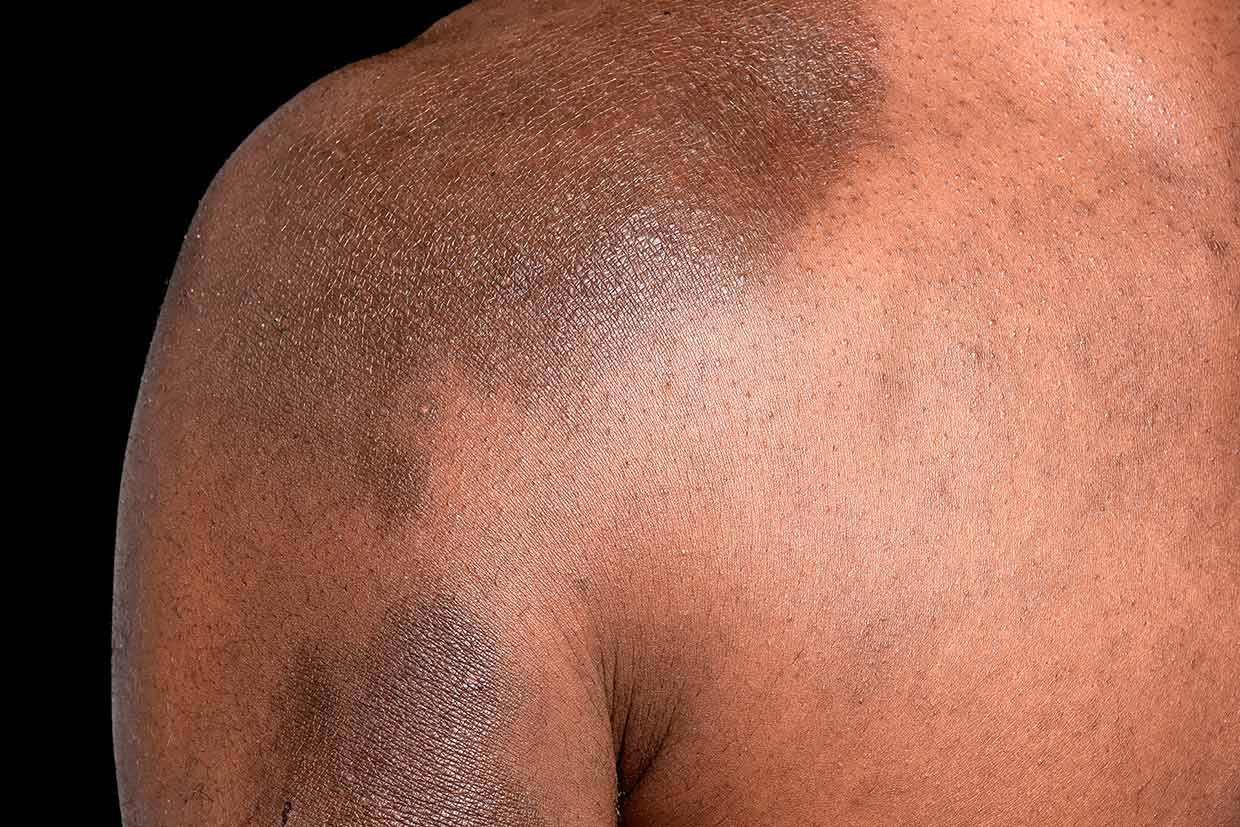 Eczema on Shoulder