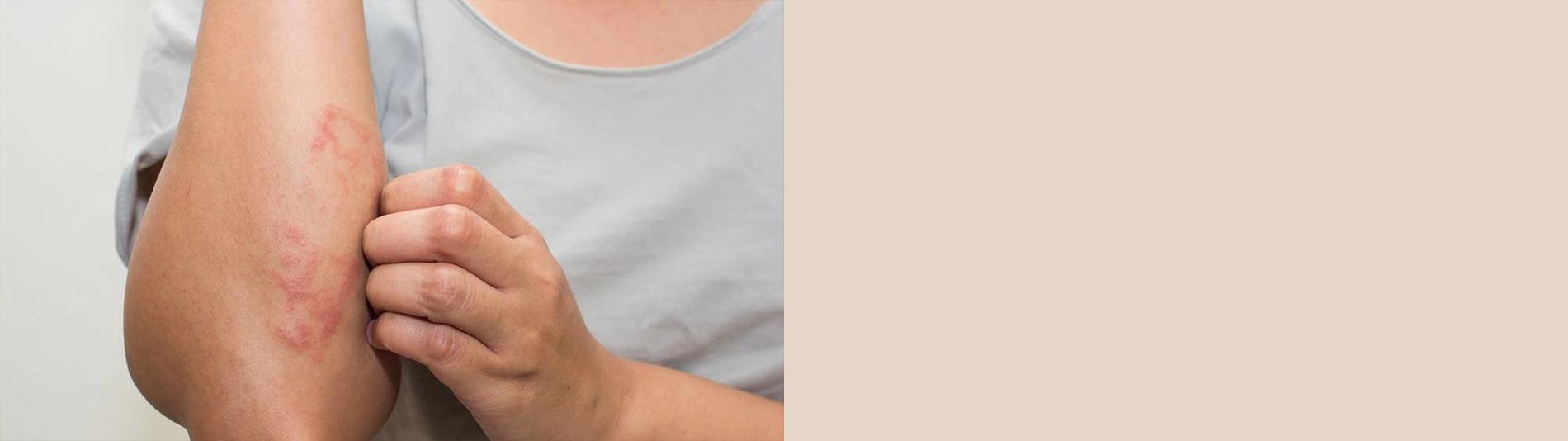 Woman touching arm with Eczema
