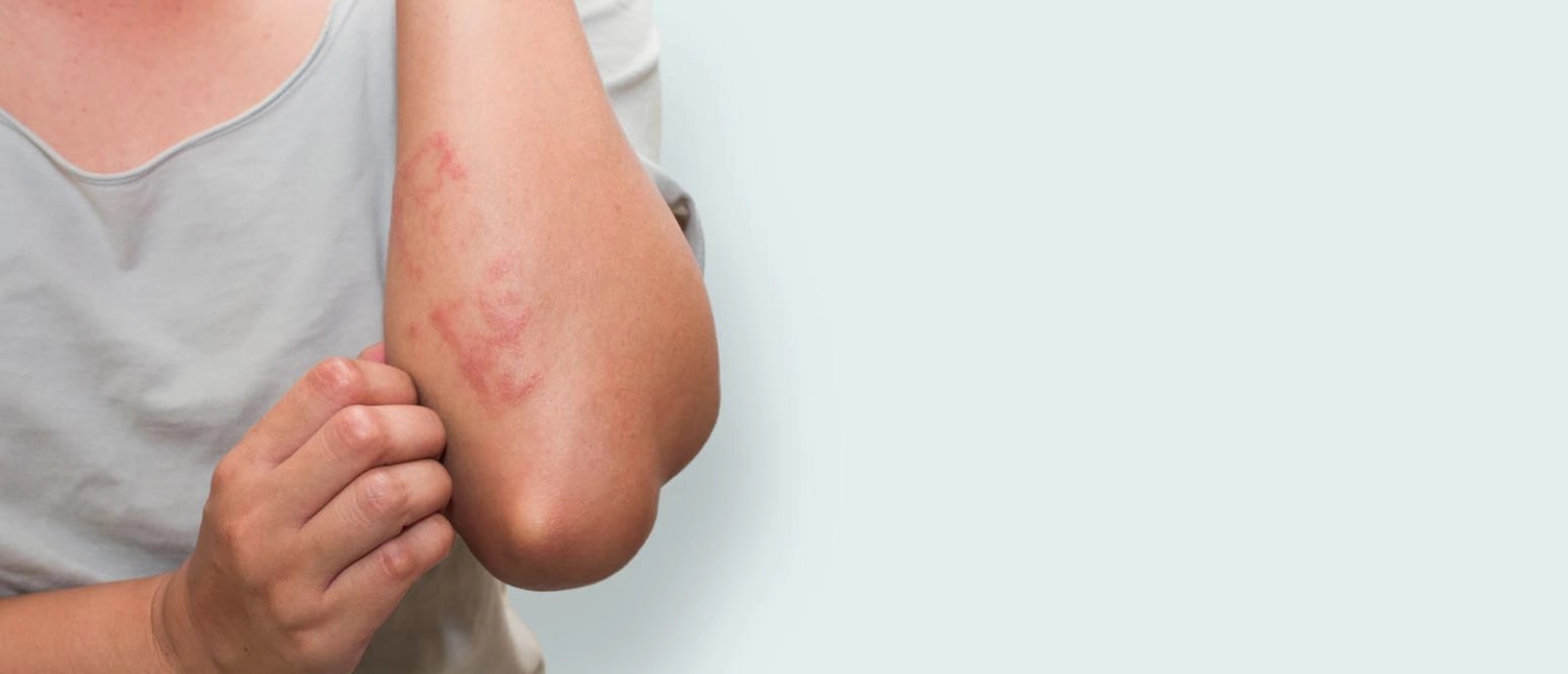 Woman scratching arm with Eczema