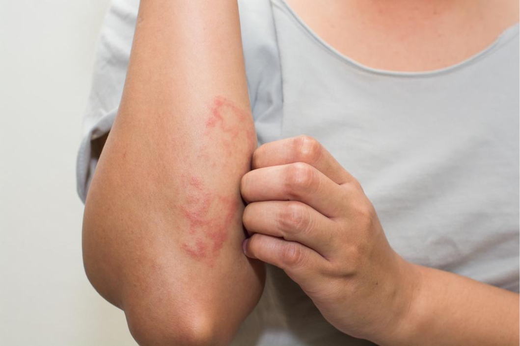 Scratching forearm with eczema